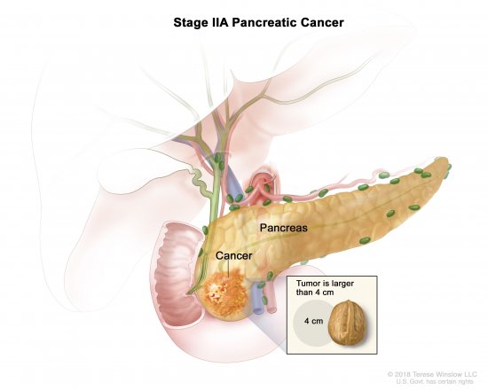 PANCREATIC CANCER