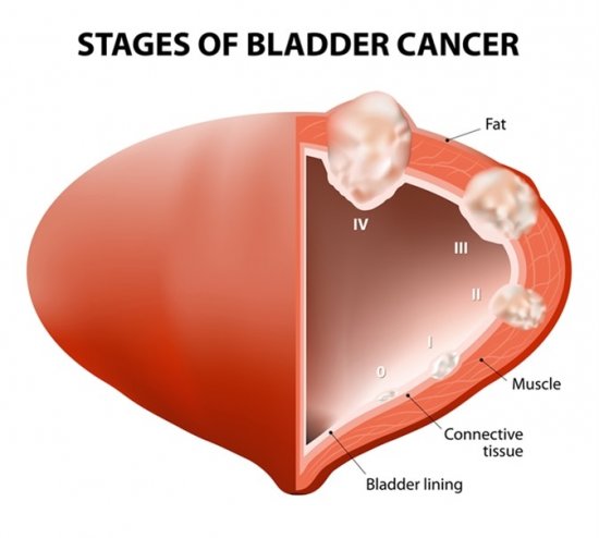 BLADDER CANCER: Types And Symptoms